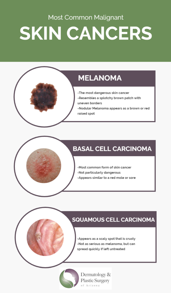 melanoma cancerous skin tags pictures