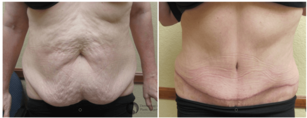 What Is an Inverted T Tummy Tuck?