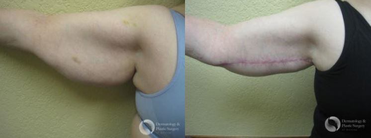 What's the Best Treatment for Flabby Arms?, Tucson Arm Lift